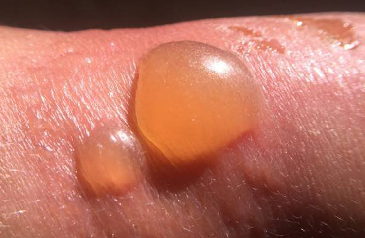 Giấc mơ về bỏng không chỉ đơn thuần là hình ảnh